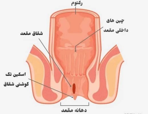  لیزر شقاق در بارداری