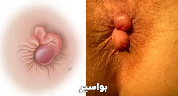  لیزر هموروئید در بارداری