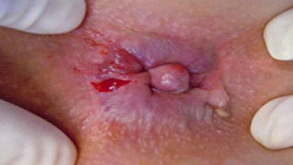  لیزر هموروئید در بارداری