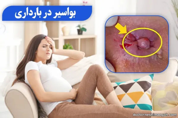 خونریزی بواسیر در بارداری
