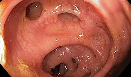  خونریزی بواسیر در بارداری