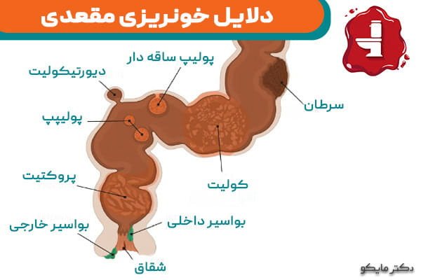  خونریزی بواسیر در بارداری