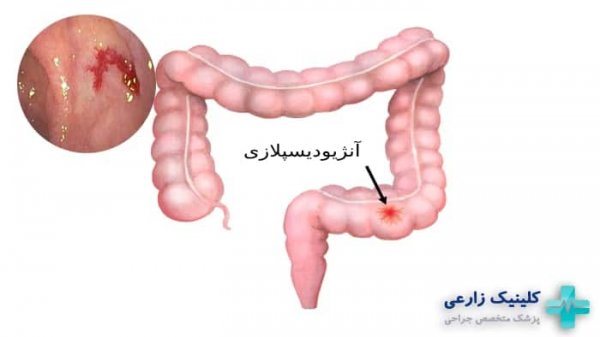  خونریزی بواسیر در بارداری