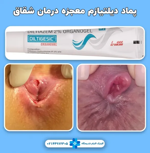  بیرون زدگی شقاق در بارداری