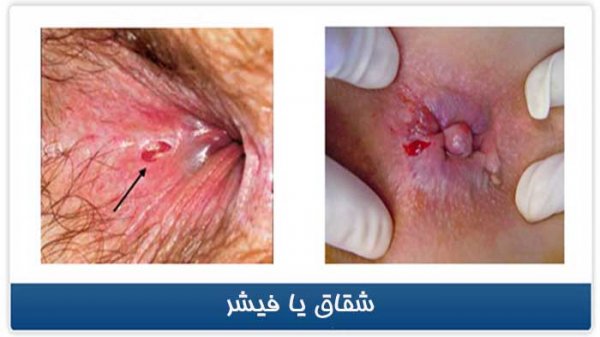  بیرون زدگی شقاق در بارداری
