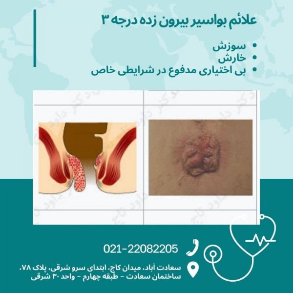  بیرون زدگی شقاق در بارداری