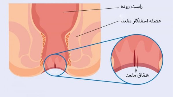 بیرون زدگی شقاق در بارداری