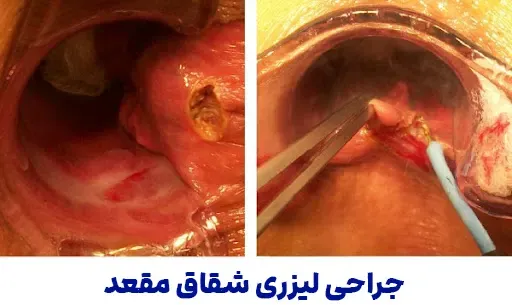  بیرون زدگی شقاق در بارداری