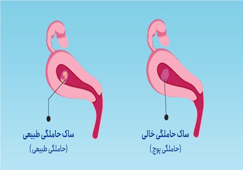  جلوگیری از بارداری پوچ با طب سنتی