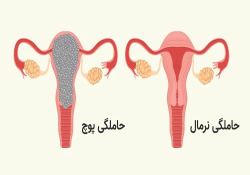  جلوگیری از بارداری پوچ با طب سنتی
