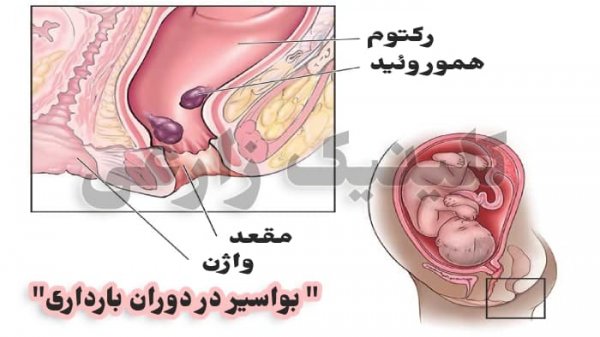  درمان سریع بواسیر بعد از زایمان طبیعی