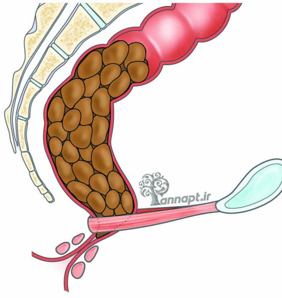  بیوفیدبک مقعدی چیست؟
