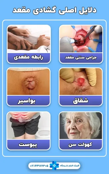  بیوفیدبک مقعدی چیست؟