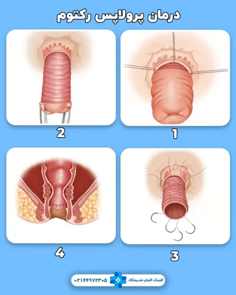 بیوفیدبک مقعدی چیست؟