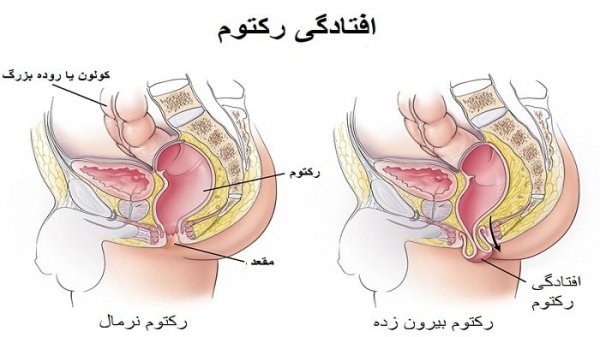  بیوفیدبک مقعدی چیست؟