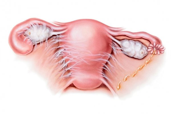 عوارض فیزیوتراپی رحم