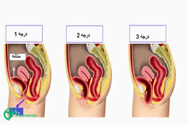  عوارض فیزیوتراپی رحم