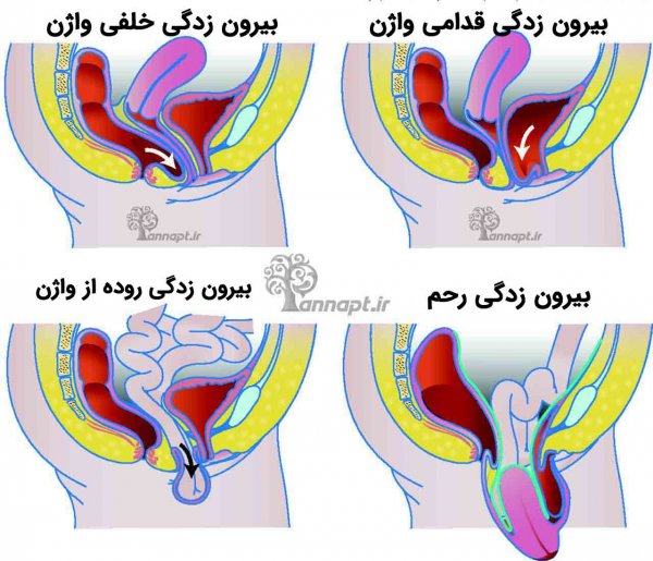  عوارض فیزیوتراپی رحم