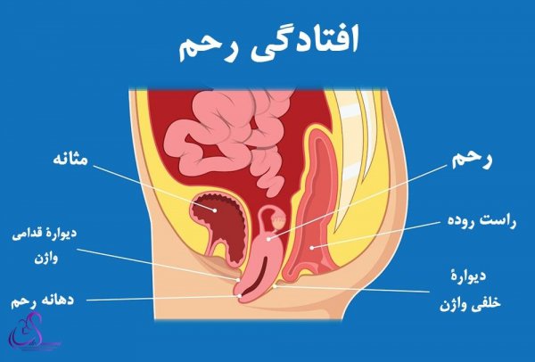  عوارض فیزیوتراپی رحم