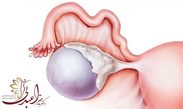  فیلم + عکس عمل کیست درموئید تخمدان با لیزر