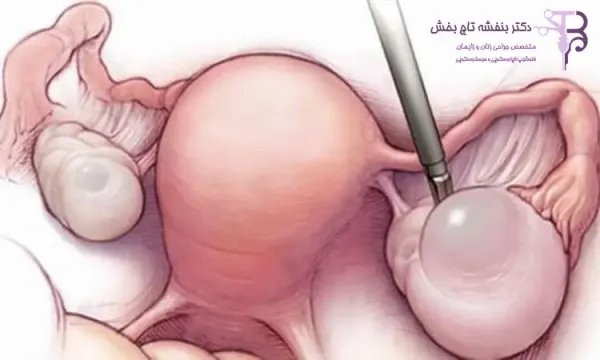  فیلم + عکس عمل کیست درموئید تخمدان با لیزر