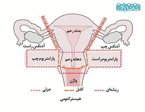  فیلم + عکس عمل کیست درموئید تخمدان با لیزر