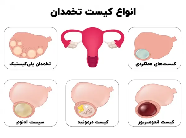  فیلم + عکس عمل کیست درموئید تخمدان با لیزر
