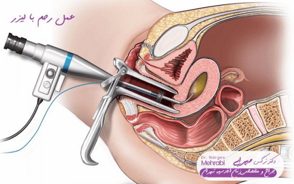  فیلم + عکس عمل کیست درموئید تخمدان با لیزر