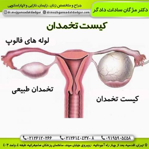  فیلم + عکس عمل کیست درموئید تخمدان با لیزر