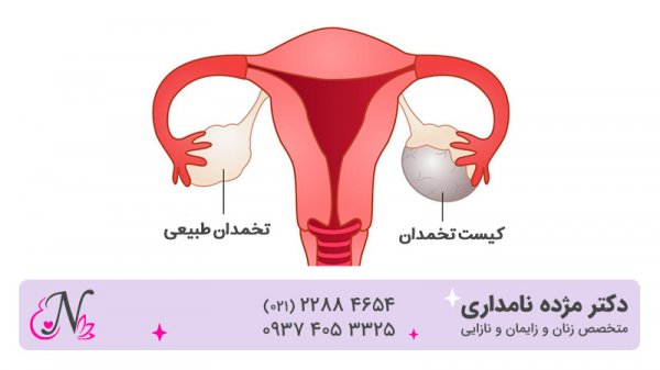  فیلم + عکس عمل کیست درموئید تخمدان با لیزر