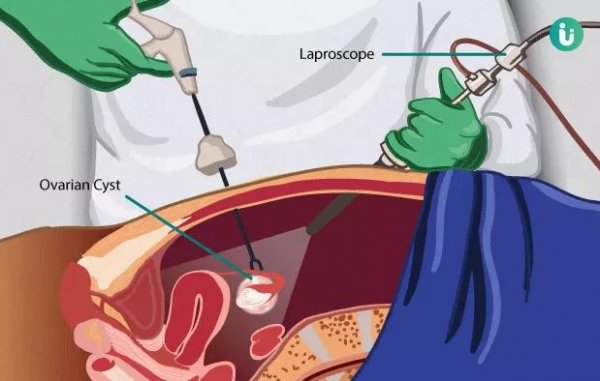  هزینه عمل کیست تخمدان با لیزر