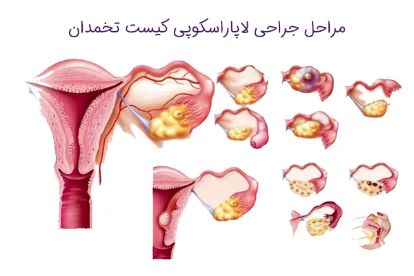  هزینه عمل کیست تخمدان با لیزر