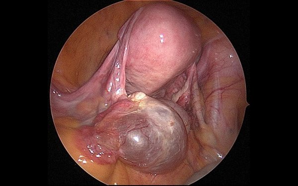  هزینه عمل کیست تخمدان با لیزر