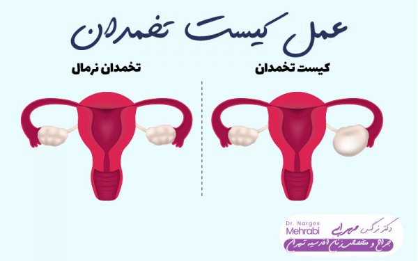  مراقبت های بعد از جراحی باز کیست تخمدان