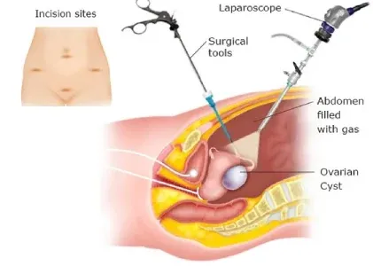  مراقبت های بعد از جراحی باز کیست تخمدان