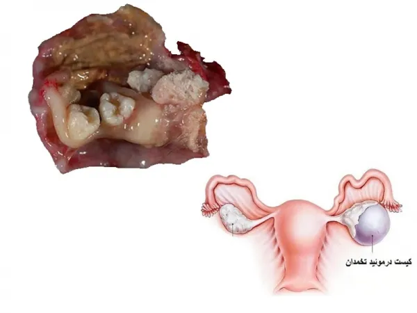 عکس کیست درموئید