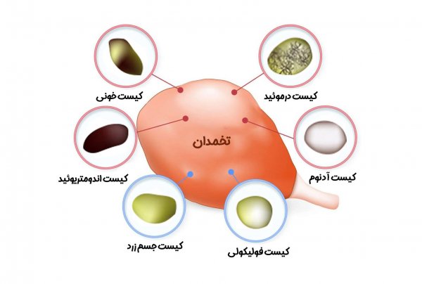  عکس کیست درموئید