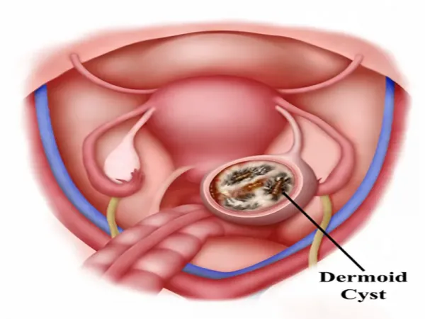  عکس کیست درموئید