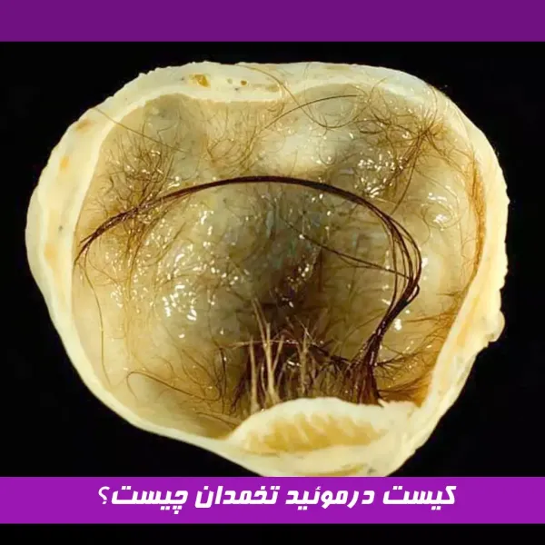  عکس کیست درموئید