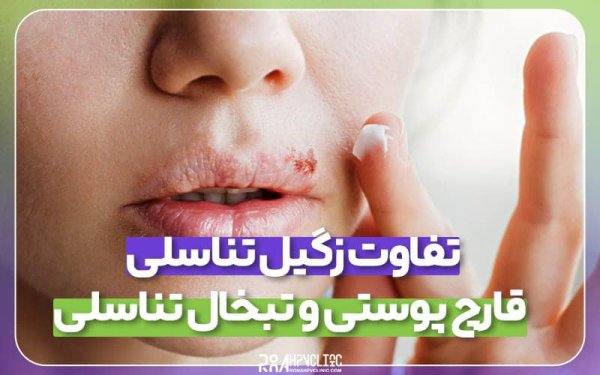 تفاوت عفونت قارچی با تبخال تناسلی