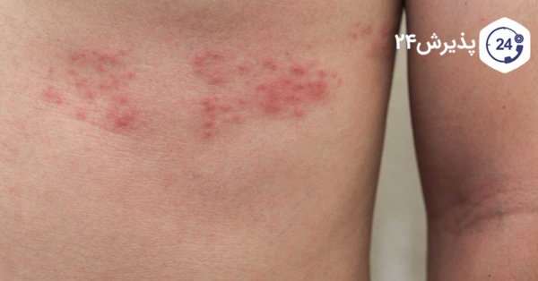  تفاوت عفونت قارچی با تبخال تناسلی