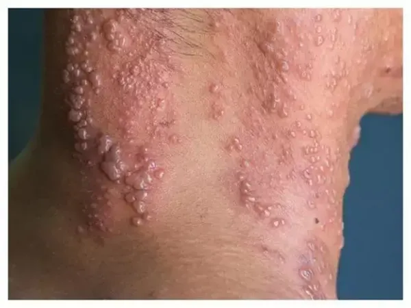  تفاوت عفونت قارچی با تبخال تناسلی