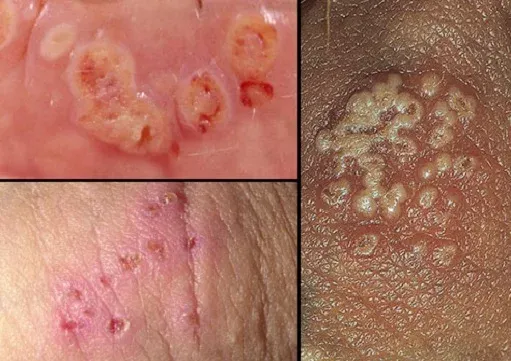  تفاوت عفونت قارچی با تبخال تناسلی