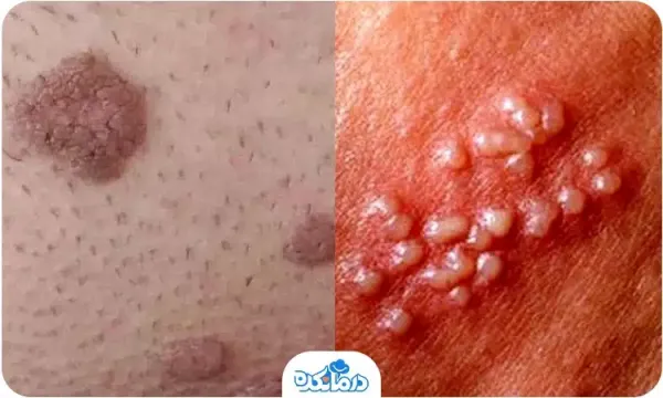  تفاوت عفونت قارچی با تبخال تناسلی