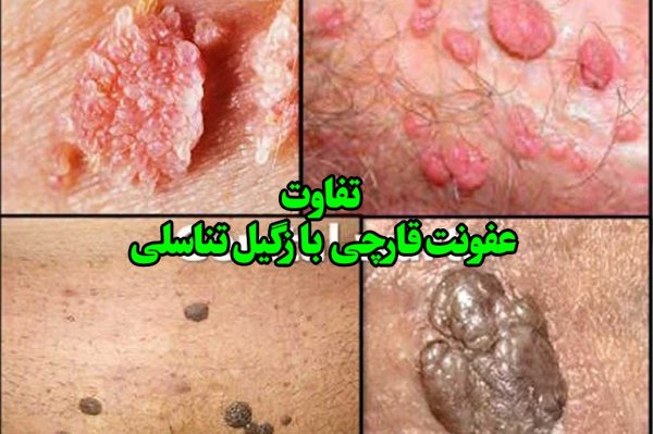  تفاوت عفونت قارچی با تبخال تناسلی