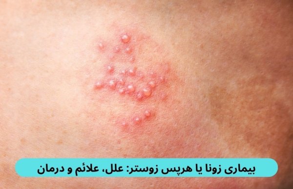 عکس بیماری زونا در بزرگسالان