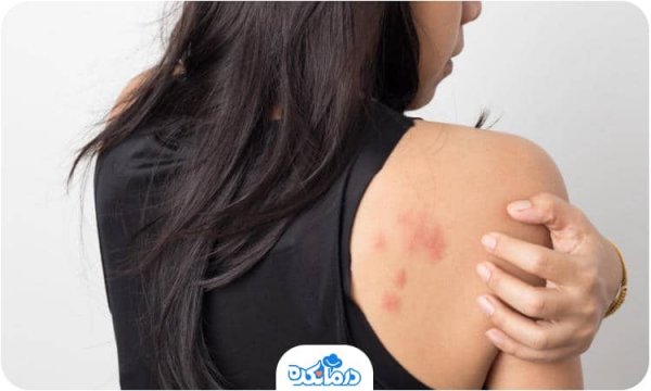  عکس بیماری زونا در بزرگسالان