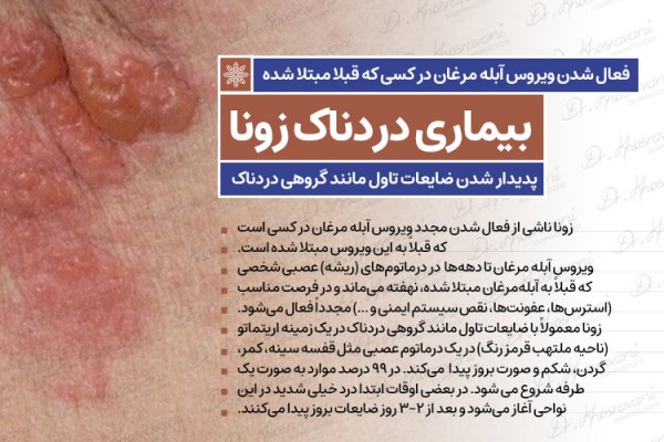  عکس بیماری زونا در بزرگسالان