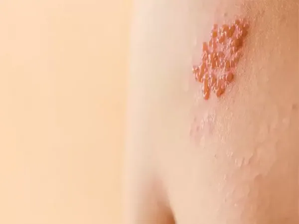  عکس بیماری زونا در زنان