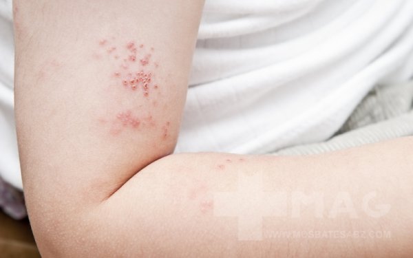  عکس بیماری زونا در زنان